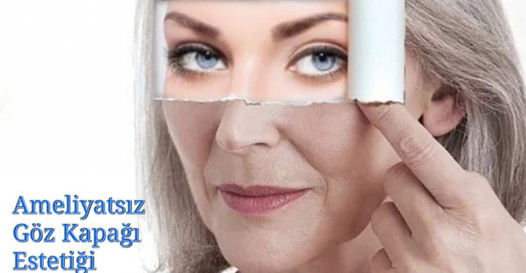 Ameliyatsız Göz Kapağı Estetiği